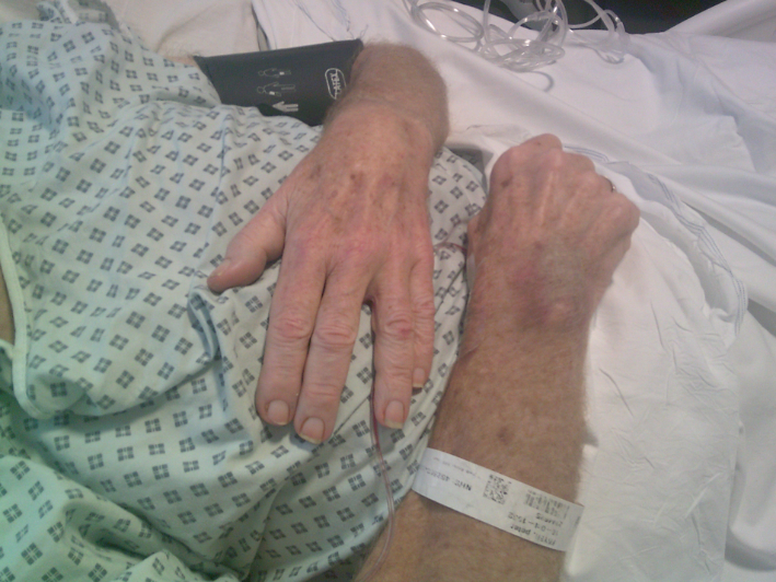 My husband was admitted to hospital on the 24th of June. He was diagnosed with pancreatic cancer back at the beginning of April of this year, and he has just been taken very poorly. Those are his hands. The are slightly bruised because they had to take something out.
- Mother participant, Bristol